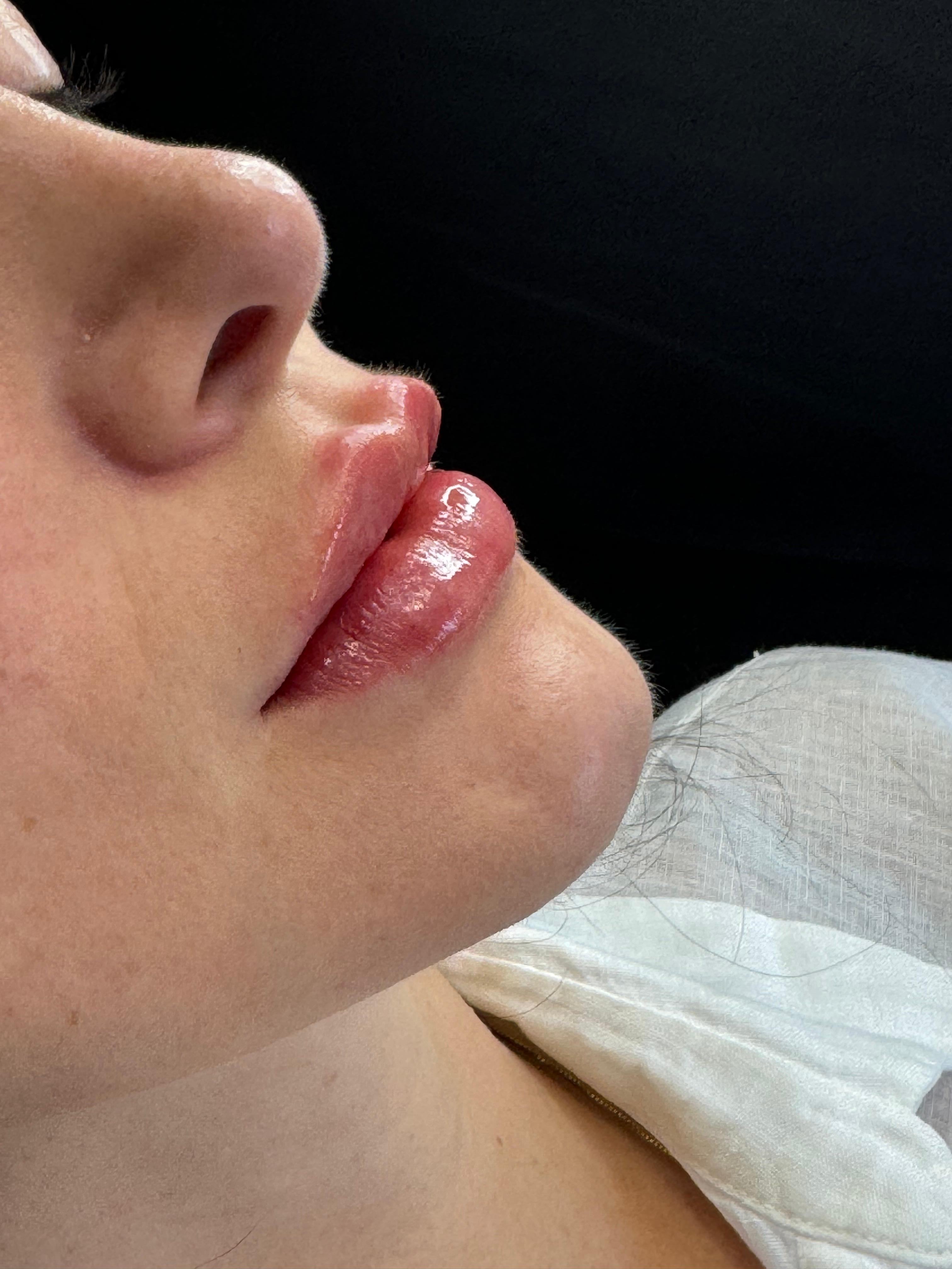 Preenchimento labial