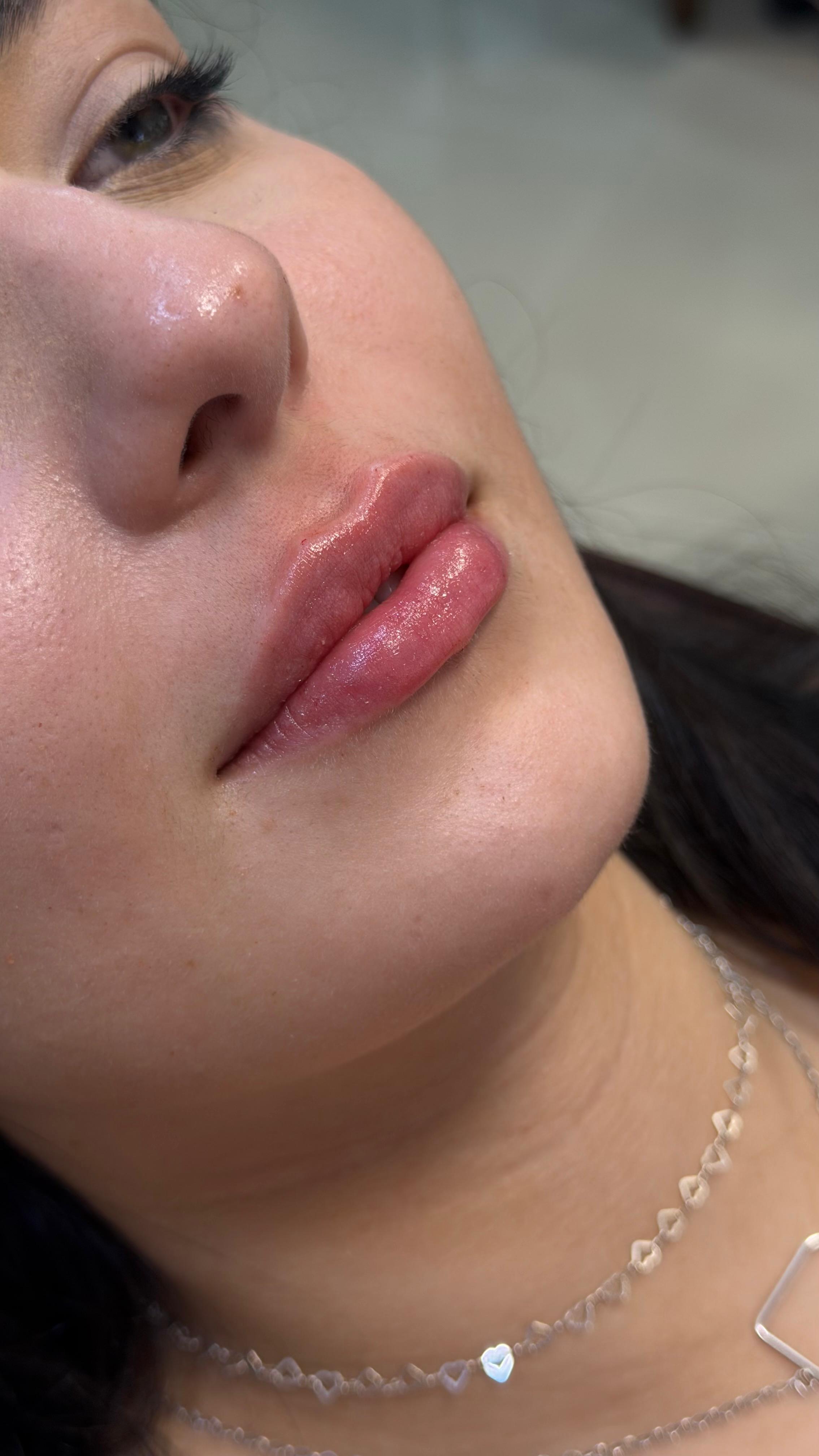 Preenchimento labial — resultado