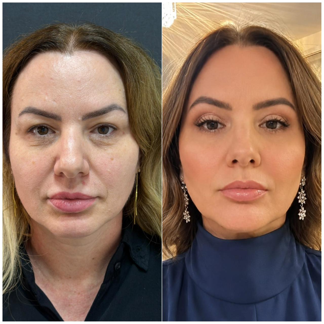 Antes e depois — rejuvenescimento
